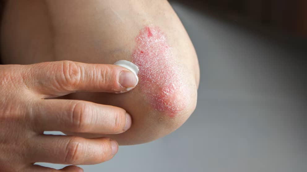 Psoriasis: un mal incurable pero que se sobrelleva con tratamiento y buenos hábitos Psoriasis: un mal incurable pero que se sobrelleva con tratamiento y buenos hábitos
